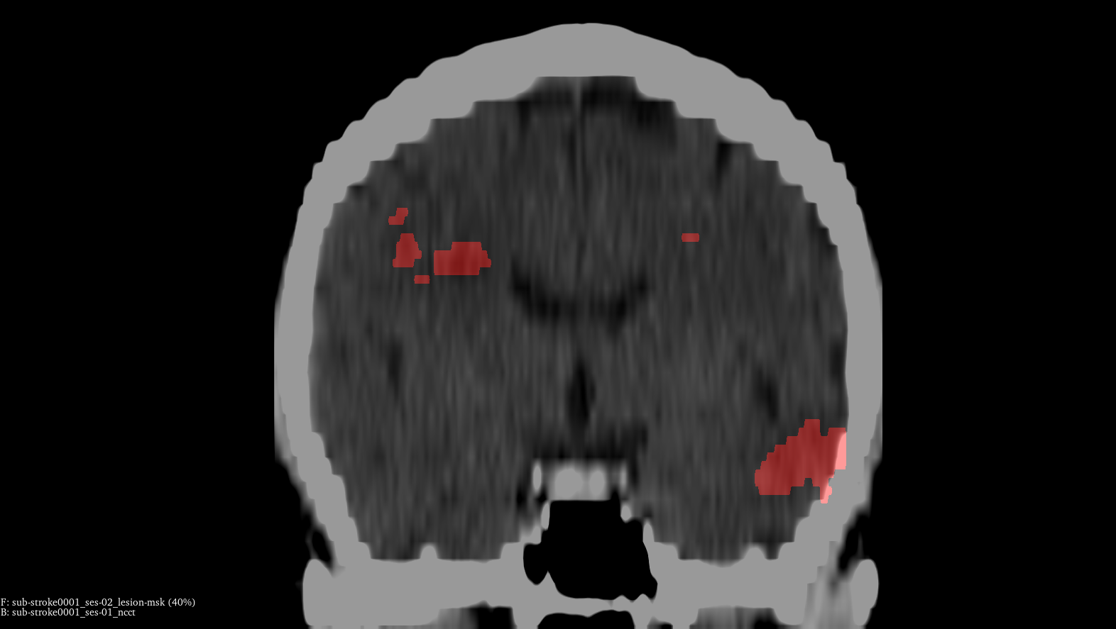 Clinical AI for Stroke Imaging